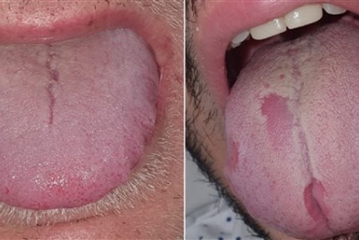 Xuất hiện triệu chứng mới của đại dịch Covid-19 