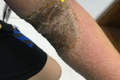 Cảnh báo biến chứng nguy hiểm do bó thuốc nam tại nhà