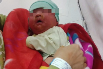 Cảnh báo: Trẻ sơ sinh bị dị ứng nặng do tắm nước lá cây