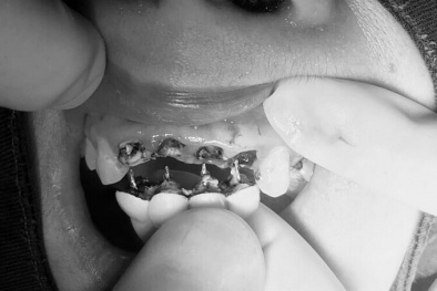 Bọc răng sứ và những biến chứng nguy hiểm ít ai ngờ