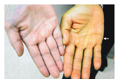 Suy gan, suy thận do uống thuốc Nam trôi nổi