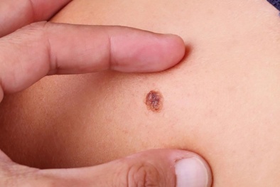 Công nghệ quang học giúp phân biệt các loại bệnh ung thư nhanh chóng