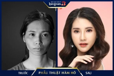 9x chia sẻ kinh nghiệm phẫu thuật hàm hô hóa 'ngọc nữ' xứ Hàn