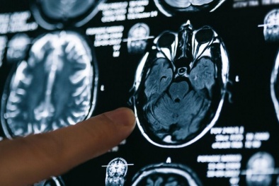 Virus làm giảm lượng chất xám trong não bệnh nhân nhiễm COVID-19