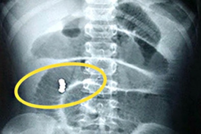Gia tăng số trẻ nuốt phải nam châm gây biến chứng nguy hiểm, cha mẹ nên cảnh giác