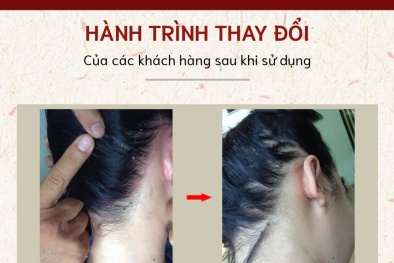 Kem bôi da liễu thiên ân có an toàn cho da không gây kích ứng?
