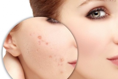 Mỹ phẩm trị mụn chứa chất Benzoyl Peroxide liều lượng cao có thể gây nguy hiểm sức khỏe