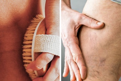 Những thói quen hàng ngày gây tổn thương cho tĩnh mạch