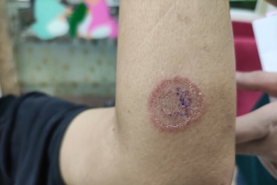 Cả gia đình nhiễm nấm da khắp người do tiếp xúc chó, mèo