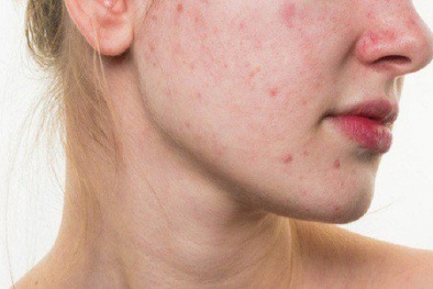 Bôi kem đánh răng lên mặt trị mụn gây nhiều tác hại, cần tuyệt đối tránh