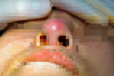 Sau nâng mũi tại spa chui, người phụ nữ bị 'mọc sừng' ra trán