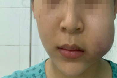 Mặt cô gái sưng phồng, nghi tiêm filler trôi nổi không đảm bảo chất lượng
