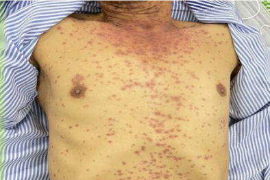 Sốt cao, toàn thân nổi mụn do uống thuốc tiểu đường không rõ nguồn gốc