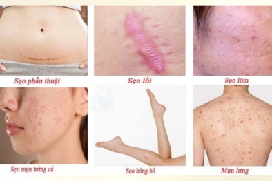 Cảnh giác kem trị sẹo không rõ nguồn gốc kinh doanh trên chợ mạng