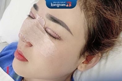 Nâng mũi cấu trúc- giải pháp tối ưu cho những người nâng mũi bị hỏng