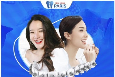 Cách niềng răng mang lại hiệu quả tốt nhất cho cả trẻ em và người lớn