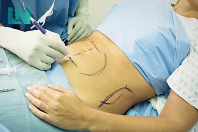 Cảnh báo tình trạng hút mỡ bụng gây nguy hiểm, có thể tử vong