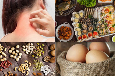 Thực phẩm dễ gây dị ứng nhất