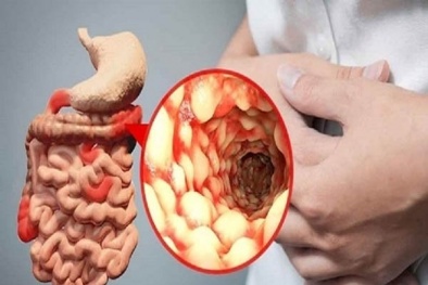 Căng thẳng có phải là nguyên nhân gây ra bệnh Crohn?