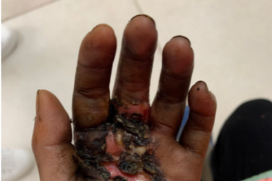 Bàn tay bé gái bị lở loét nghiêm trọng do tự ý đắp lá cây chữa viêm da