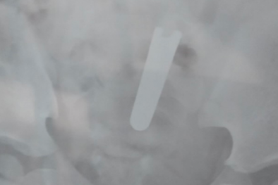 Nuốt phải nắp nhíp bấm móng tay, trẻ 2 tuổi ở Cao Bằng nhập viện