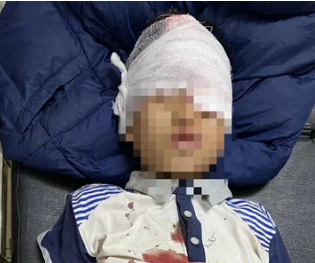 Cận Tết, thêm nhiều bé trai bị thương nặng do nghịch pháo