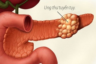 Phát hiện mới: Thuốc trị huyết áp có thể giúp kiềm chế ung thư tuyến tụy