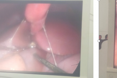 Cảnh báo nguy cơ thủng dạ dày ở trẻ em nhiễm Covid-19 