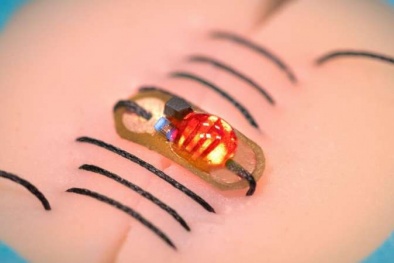 Phát triển thành công loại chỉ khâu có khả năng cảnh báo biến chứng sau phẫu thuật