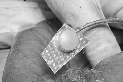 Một phụ nữ bị thủng ruột do lơ đễnh uống thuốc còn nguyên vỏ bọc