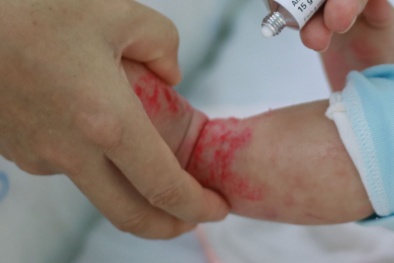 Nhiều trẻ bị hủy hoại làn da do cha mẹ tự ý điều trị viêm da tại nhà