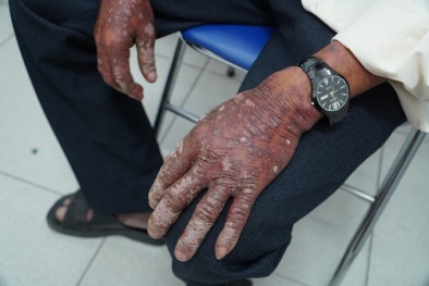 Người đàn ông bị rộp da toàn thân do nhiễm độc thuốc diệt cỏ