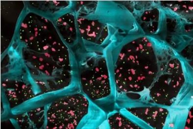 Hydrogel giải phóng thuốc ngăn ngừa ung thư tái phát sau phẫu thuật