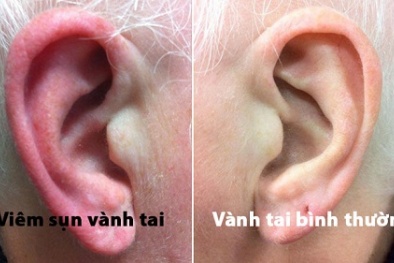 Nhiễm trùng nghiêm trọng sau khi bấm lỗ tai