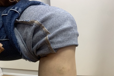 Hoại tử chân do đắp thuốc nam chữa bầm tím