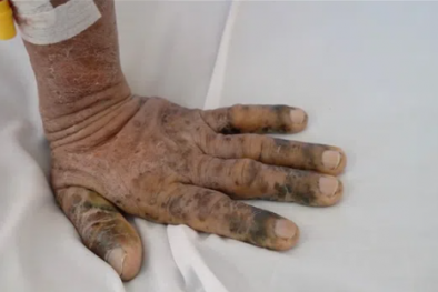 Nhiễm độc thuốc nam: Nhiều người vẫn 'tiền mất, tật mang' dù đã được cảnh báo 