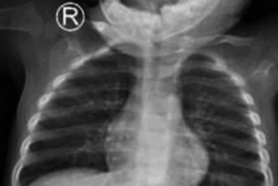 Cảnh báo nguy cơ do sử dụng đồ chơi nguy hiểm