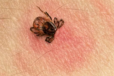 Nguy kịch khi bị sốt do mò cắn