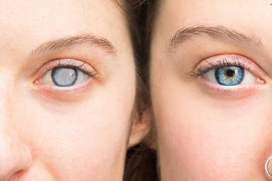 Thuốc điều trị đục thủy tinh thể- Niềm hy vọng về phương pháp điều trị mới thay phẫu thuật