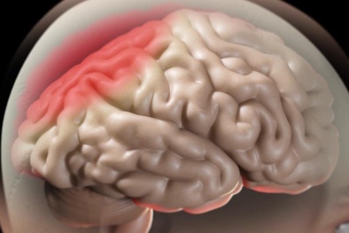 Uống rượu dù lượng vừa phải vẫn có thể khiến não bị lão hóa nhanh