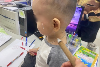 Trẻ nhỏ bị liệt mặt do nằm quạt thốc thẳng vào sau gáy, cách sử dụng quạt điện an toàn