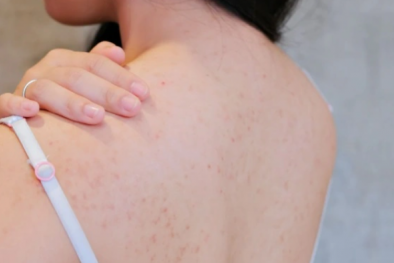 Dùng thuốc gây tê khi lăn kim chữa mụn có thể gây khó thở, rối loạn tri thức