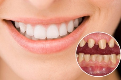 Bác sĩ nha khoa cảnh báo tác hại không mong muốn nếu bọc răng sứ giá rẻ, kém chất lượng 