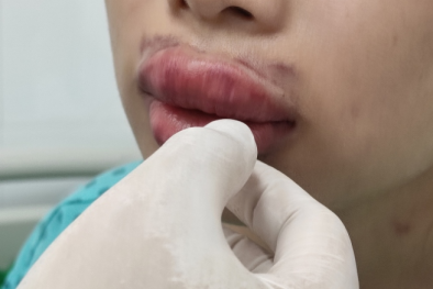 Sau tiêm filler 'Hàn Quốc' giá rẻ khiến môi sưng phồng, nhiễm trùng nặng