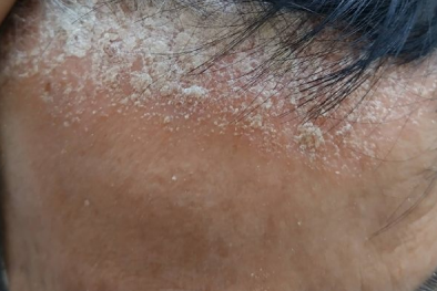 Dùng thuốc nhuộm tóc có thành phần hóa chất mạnh gây ửng đỏ, gàu mọc từng mảng trắng 