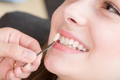 Trồng răng khểnh bằng nhựa và răng kém chất lượng tác hại khôn lường