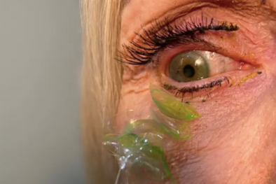 Người sử dụng suýt mù vĩnh viễn vì bỏ quên 23 chiếc kính áp tròng trong mắt