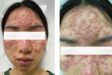 Đắp mặt nạ không rõ thành phần tại spa, cô gái phải nhập viện cấp cứu