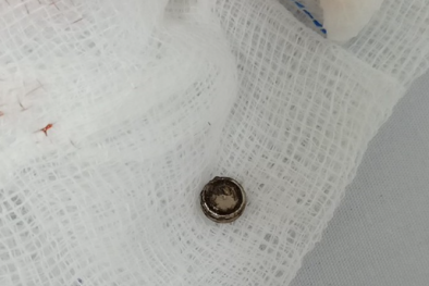 Pin cúc áo đồ chơi mắc kẹt trong mũi bé gái gây loét, viêm mũi