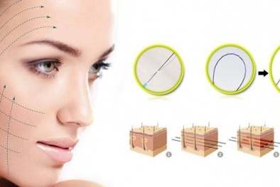 Căng chỉ collagen liệu có an toàn, những lưu ý cần biết trước khi căng chỉ da mặt